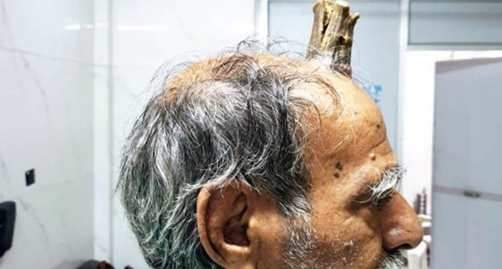 Extirpan un extraño cuerno de la cabeza de un hombre en hospital de la India