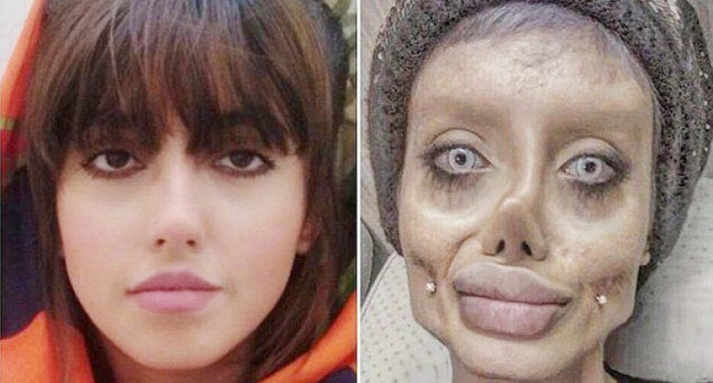 Arrestan joven se hizo cirugía plástica para parecerse a Angelina Jolie