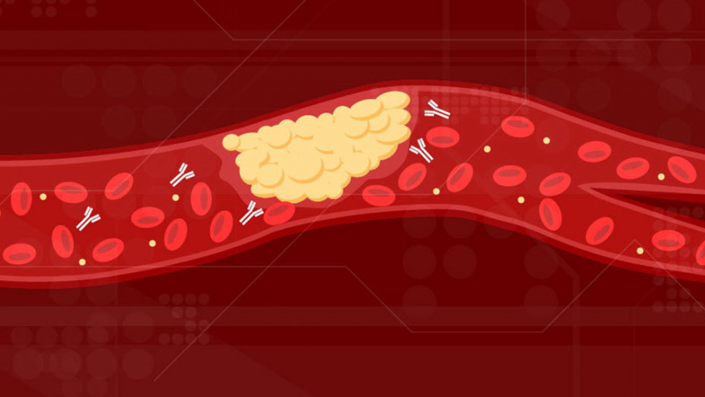 Científicos hallan por qué se forman coágulos de sangre potencialmente mortales en pacientes con covid-19 Coagulos large