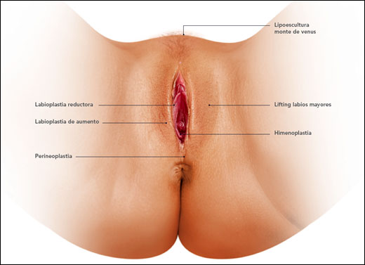 himen oplastia eljacaguero