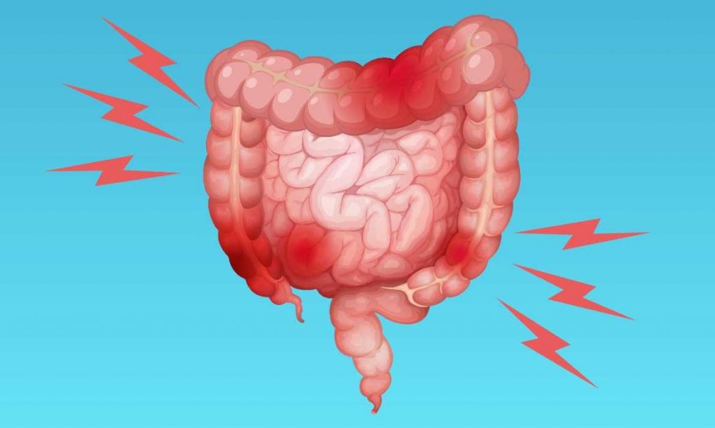 inflamacion intestinal