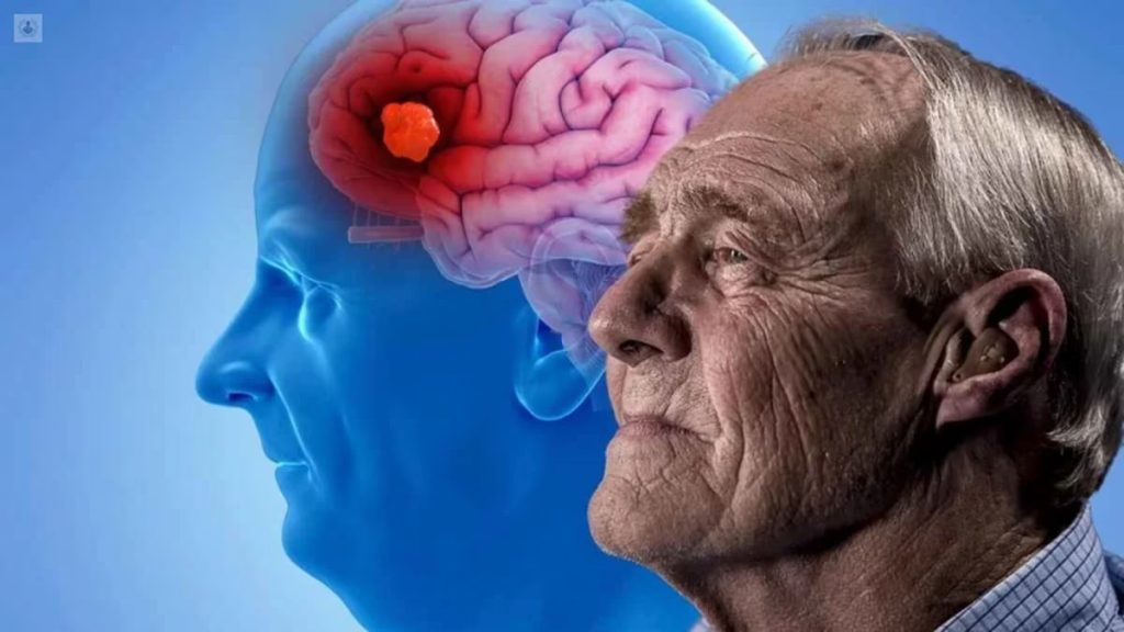 Alzheimer y la esclerosis multiple eljacaguero1