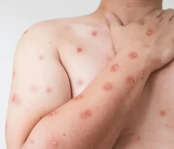 Rara enfermedad en NYC con 8.5 millones de habitantes; entre ellos 900 mil dominicanos Rara enfermedad se propaga por NYC