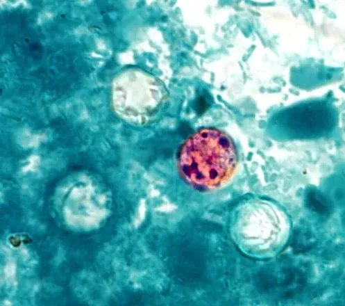 Parásito Ciclosporiasis: Aumentan casos de diarrea grave en NYC y otros estados; dominicanos en alerta Parasito ciclosporiasis causa grave diarrea aumenta en NYC y otros estados dominicanos en alerta