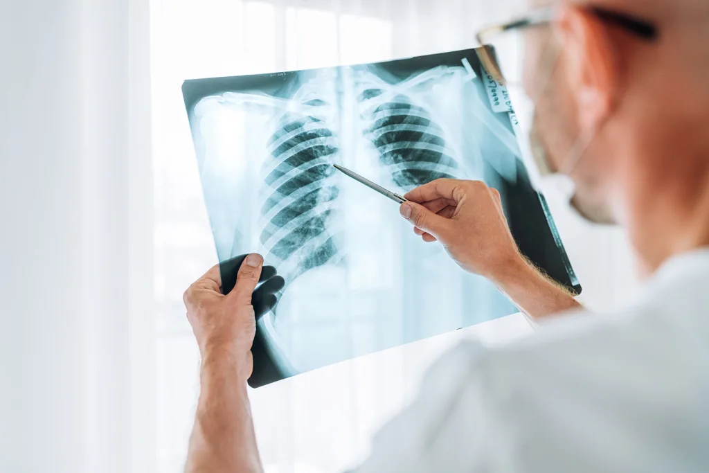 La innovación abre nuevas posibilidades para pacientes con cáncer de pulmón en etapas tempranas MCI HERO 1