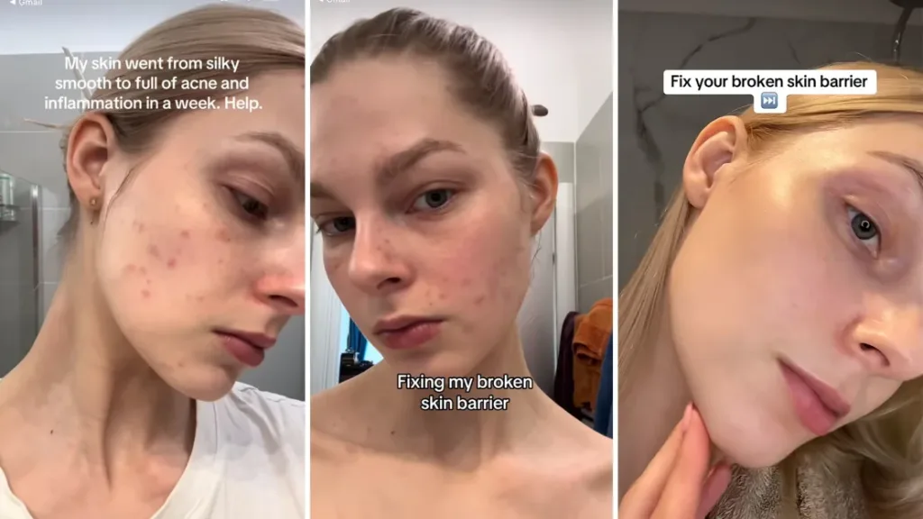 “Glass skin” bajo alerta: la tendencia viral que promete piel perfecta puede terminar dañándola